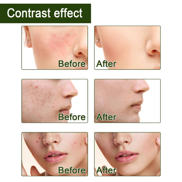 TEA TREE OIL - Ulje protiv akni - Slika 8
